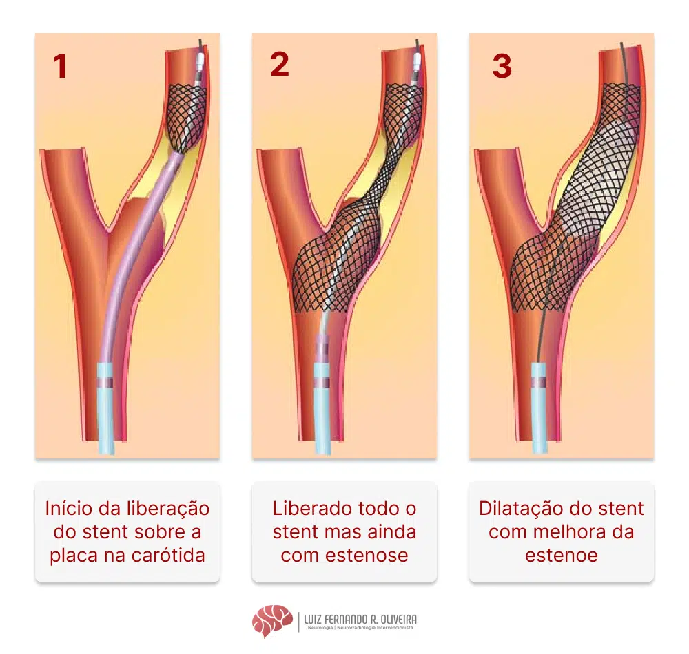 Angioplastia da carótida stent Tratamento da doença carotídea