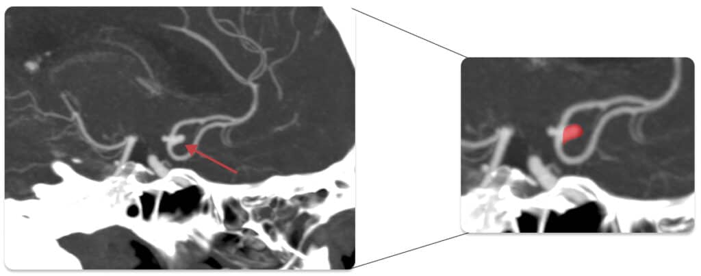 Angiotomografia evidencia aneurisma cerebral.