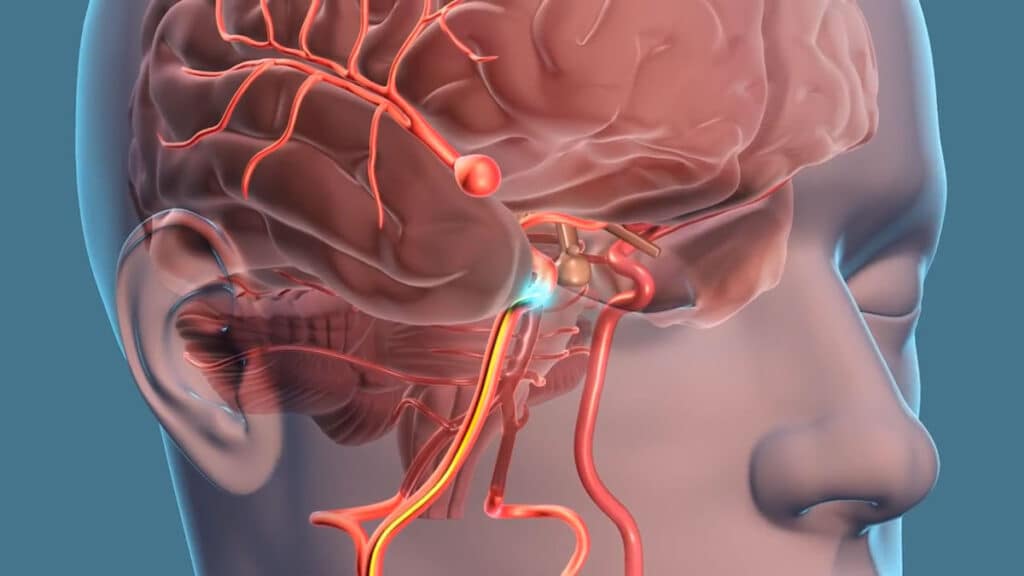 aneurisma cerebral - o que é, causas, sintomas e tratamento