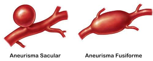 Existem diferentes tipos de aneurismas cerebrais