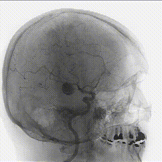A angiografia pode mostrar os vasos e lesões em 3D.