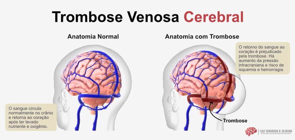 Trombose Venosa Cerebral Causas Sintomas Tratamento E Recuperação 7244