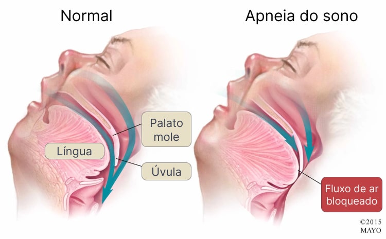 O relaxamento da língua, palato e musculatura da faringe obstrui a passagem de ar e causa apneia.