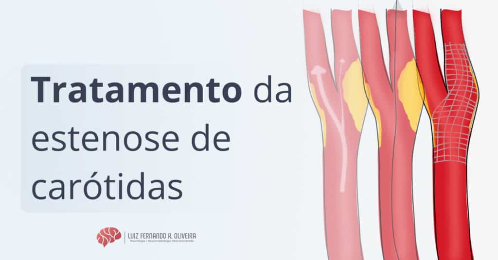angioplastia de carótida para tratamento da estenose carotídea