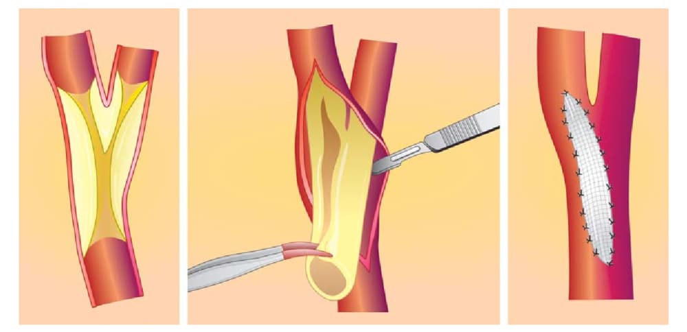 Passos da endarterectomia de carótida.