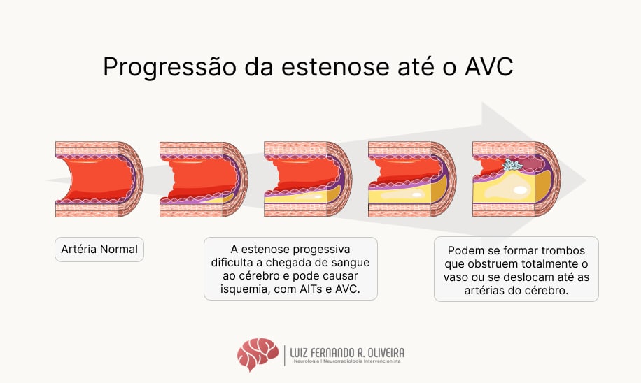 infografico da progressão da estenose de carótida causando AVC