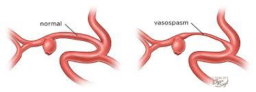 Ilustração de vasoespasmo na HSA