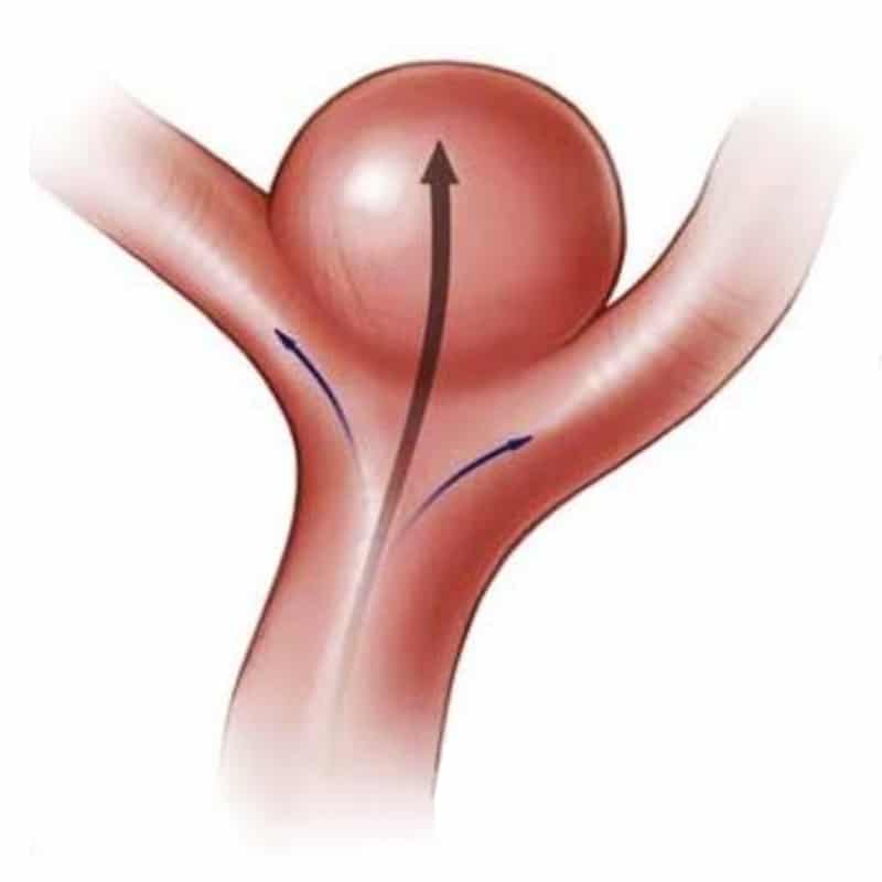 Aneurismas são mais comuns em regiões de bifurcação, onde há maior estresse do fluxo sanguíneo.