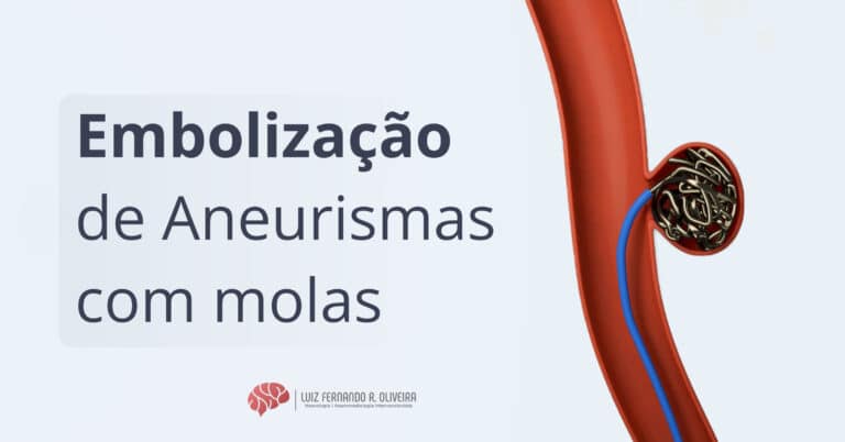 Como é a embolização de aneurismas cerebrais