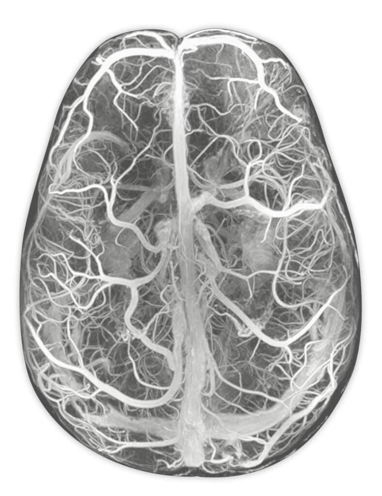 Ressonância dos vasos cerebrais