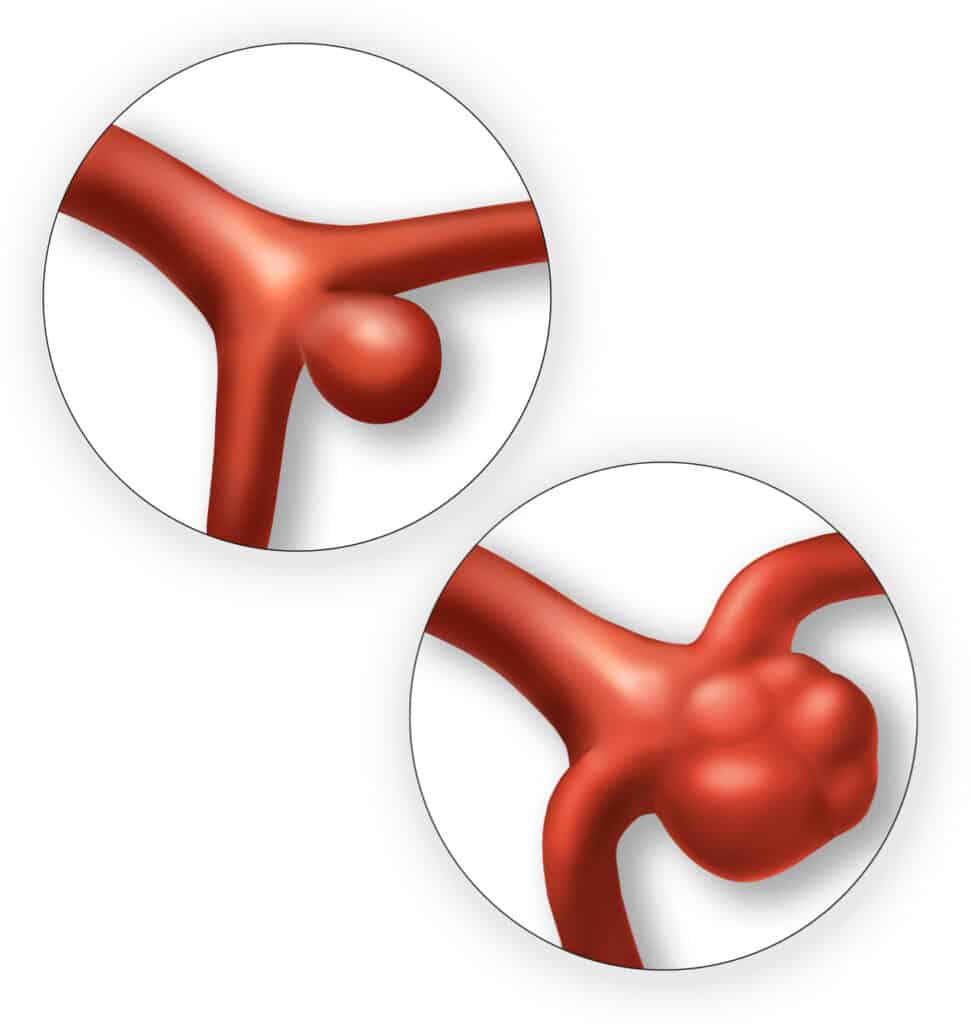 Tipos de Aneurismas Cerebrais: colo largo ou colo estreito