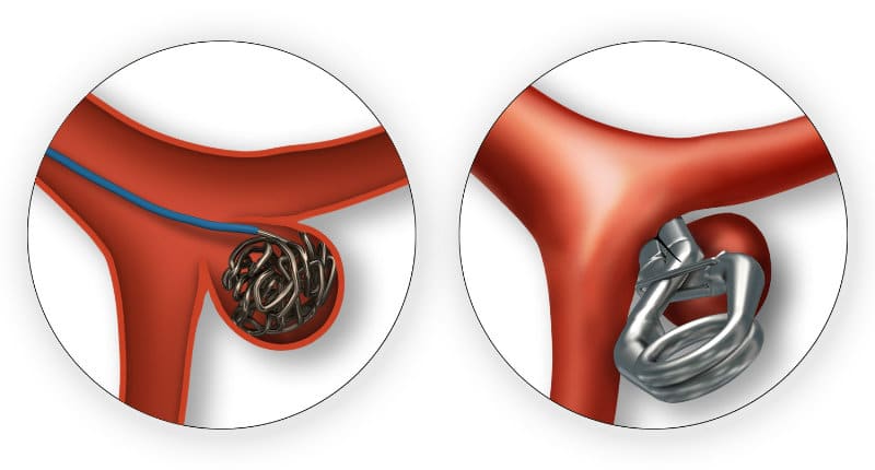 O clipe é colocado por fora do aneurisma as molas são colocadas por dentro.