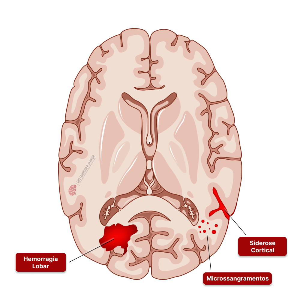 Angiopatia amiloide causa diferentes tipos de hemorragia cerebral