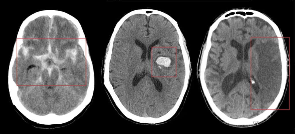 Tomografia com diferentes tipos de AVC.