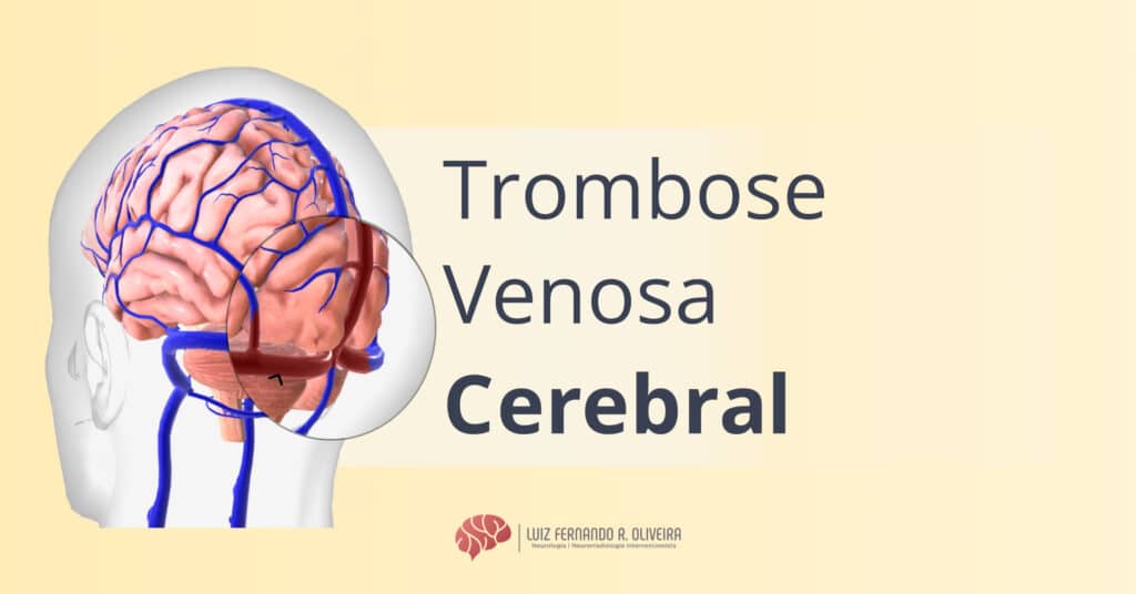 Trombose Venosa Cerebral