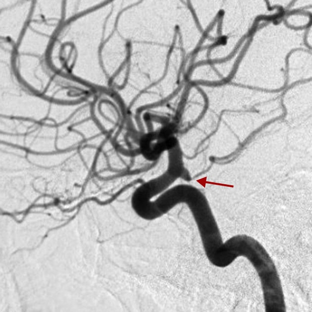Angiografia cerebral digital  confirma o infundíbulo da artéria comunicante posterior