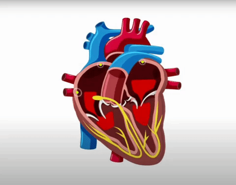 Animação de uma arritmia fibrilação atrial deslocando coágulo e causando AVC