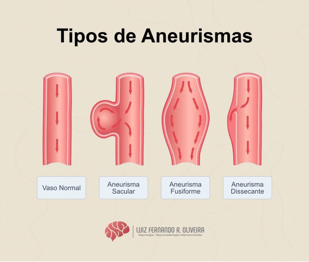 Ilustração dos diferentes tipos de aneurismas cerebrais.