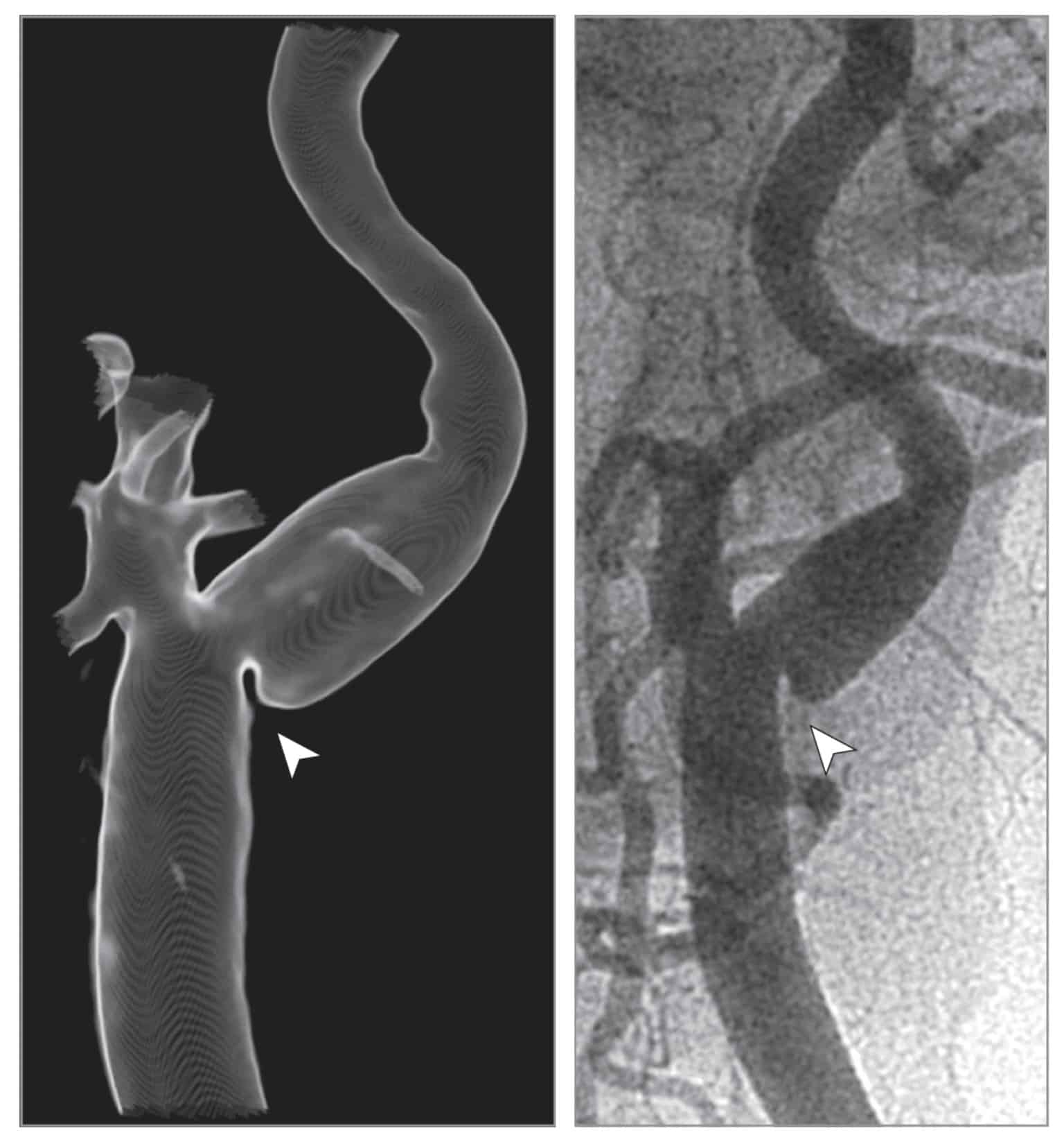 Imagens de angiografia e reconstrução 3D de um web de carótida