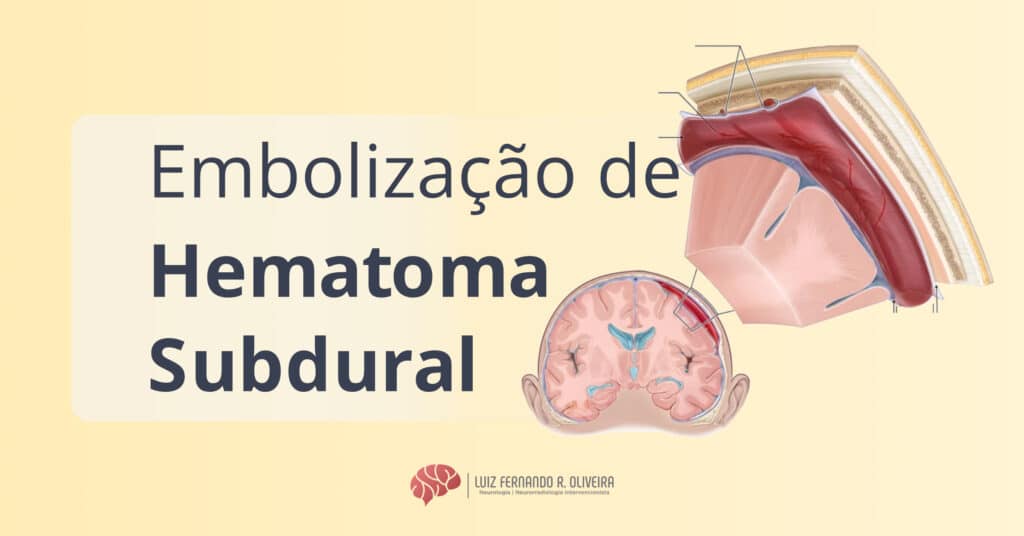 Titulo de artigo sobre Embolização da Artéria Meníngea média para Tratamento do Hematoma Subdural mostrando uma ilustração do hematoma
